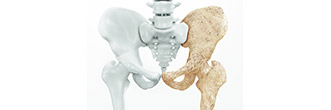 Osteoporoza - preventie, cauze, diagnostic si tratament